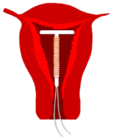 اللولب للي عندهم أستفسارات عالم حواء