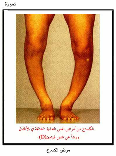 حكاية بنتي مع لين العظام للفائدة الصفحة 9 عالم حواء